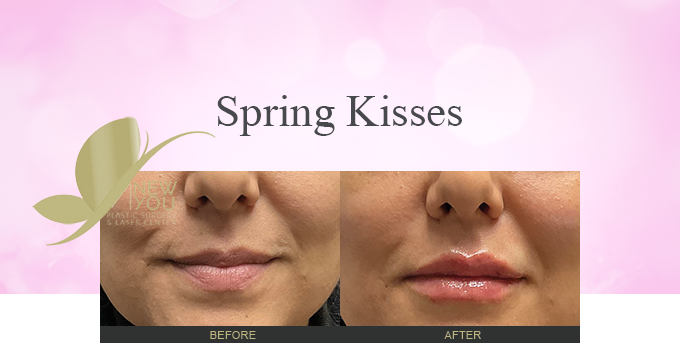 Click here to read our Lip Filler blog
