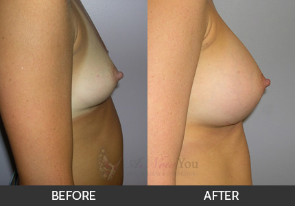 Breast Augmentation Gallery