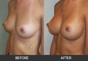 breast-augmentation-02-thumbs