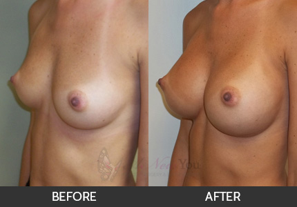 Breast Augmentation Gallery