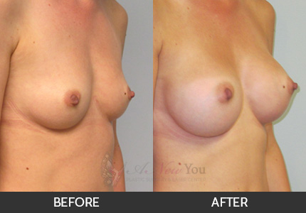 Breast Augmentation Gallery