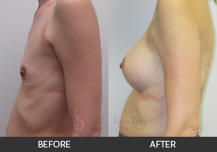 Breast Augmentation Gallery