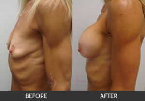 breast-augmentation-05-thumbs