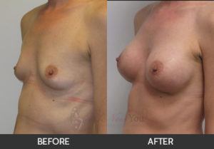 breast-augmentation-06-thumbs