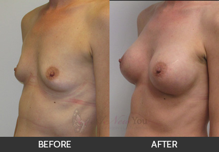 Breast Augmentation Gallery