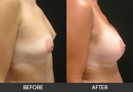 Breast Augmentation Gallery