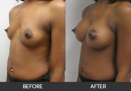 Breast Augmentation Gallery