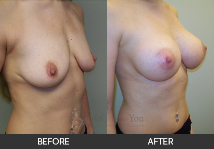 Breast Augmentation Gallery