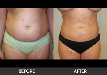 Liposuction Gallery