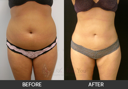 Liposuction Gallery