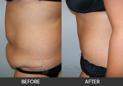 Tummy Tuck Gallery