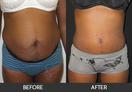 Tummy Tuck Gallery