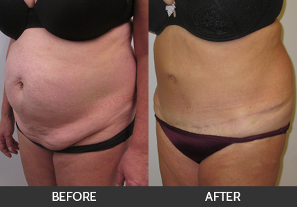 Tummy Tuck Gallery