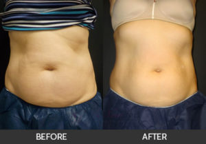 coolsculpting-01-thumbs
