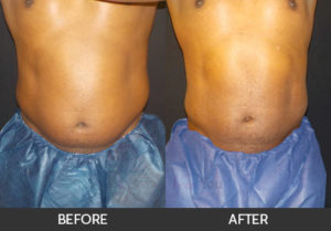 coolsculpting-02-thumbs