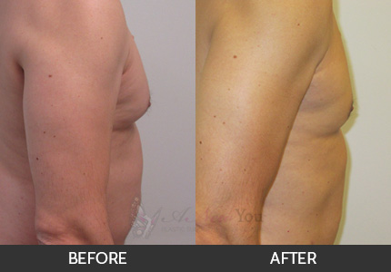 Gynecomastia Gallery