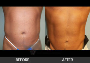 male-liposuction-01-thumbs