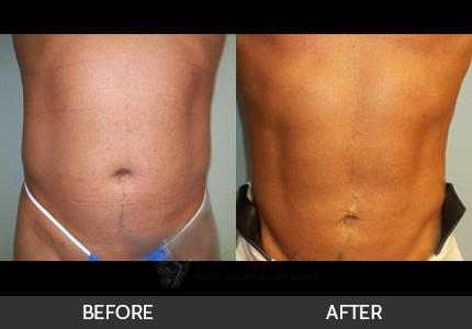 Male Liposuction Gallery