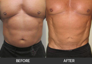 male-liposuction-02-thumbs