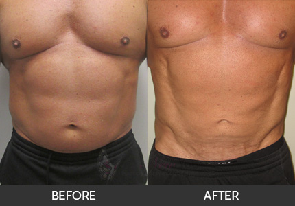 Male Liposuction Gallery