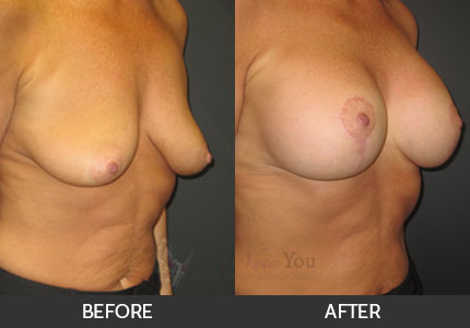 Breast Augmentation Gallery