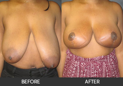 Breast Lift Gallery