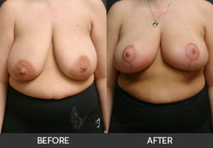 Breast Lift Gallery