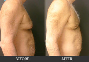 Gynecomastia Before and After, Chicago, IL