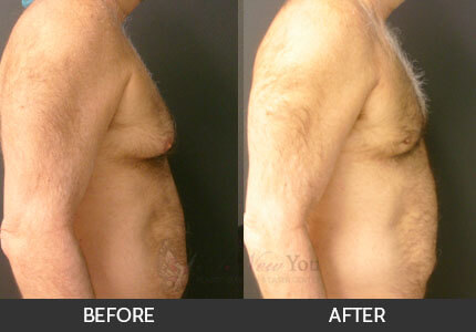 Gynecomastia Gallery