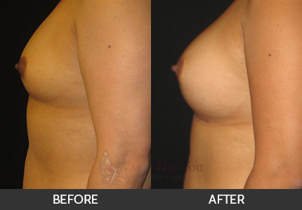 Breast Augmentation Gallery