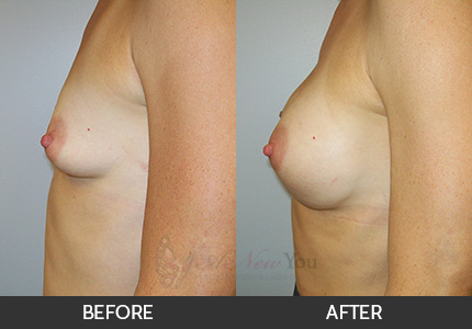 Breast Augmentation Gallery