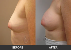 breast-augmentation-13-thumbs
