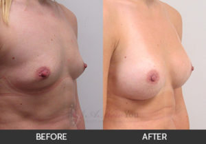 breast-augmentation-14-thumbs