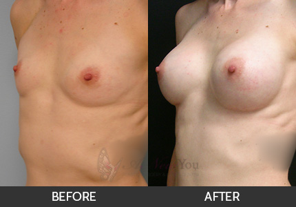 Breast Augmentation Gallery