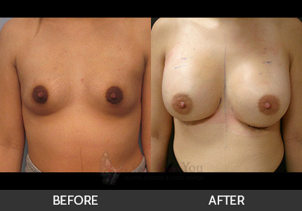 Breast Augmentation Gallery