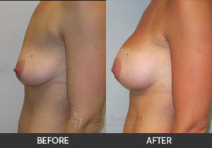 breast-augmentation-17-thumbs