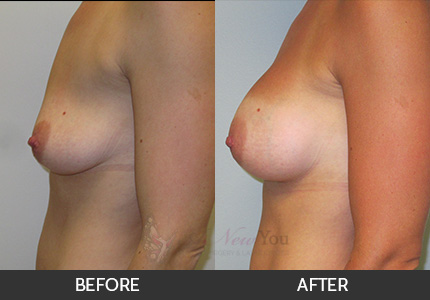 Breast Augmentation Gallery