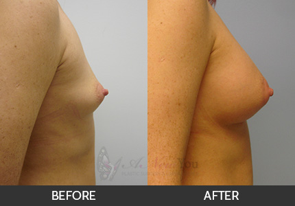 Breast Augmentation Gallery