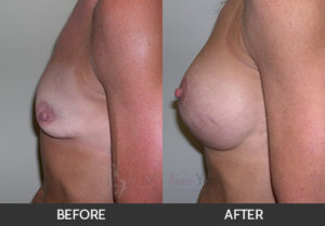 breast-augmentation-19-thumbs