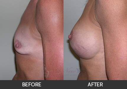 Breast Augmentation Gallery