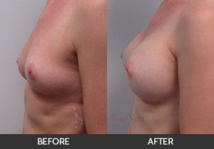breast-augmentation-20-thumbs
