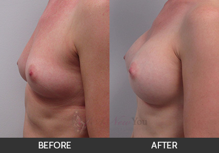 Breast Augmentation Gallery