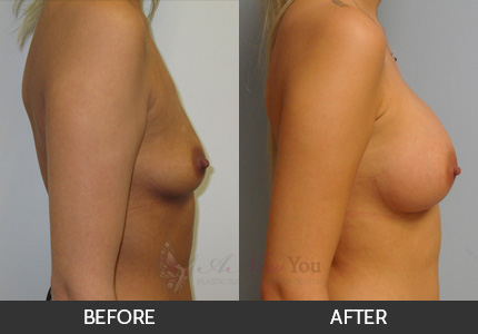 Breast Augmentation Gallery