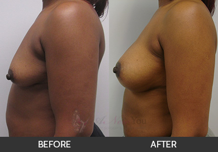 Breast Augmentation Gallery