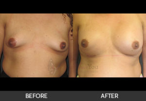breast-augmentation-23-thumbs