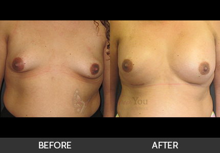 Breast Augmentation Gallery