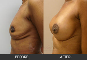 breast-augmentation-25-thumbs