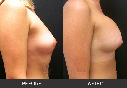 Breast Augmentation Gallery