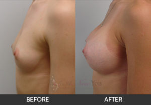 breast-augmentation-27-thumbs