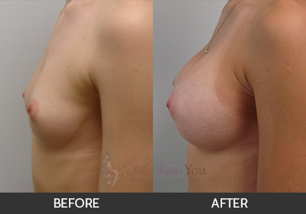 Breast Augmentation Gallery